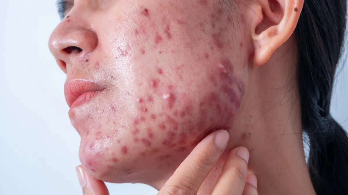 The Science Behind Hormonal Acne and Nutrition