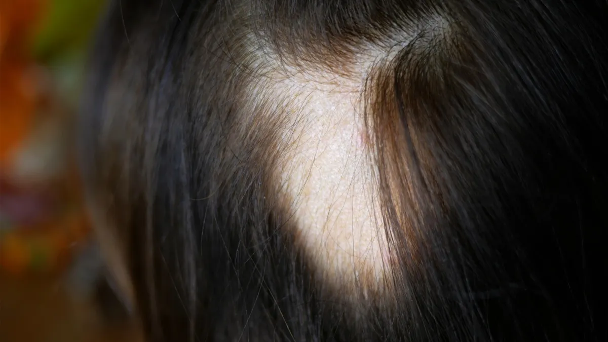Dermatologist Treatments for Hair Loss and Diagnosis
