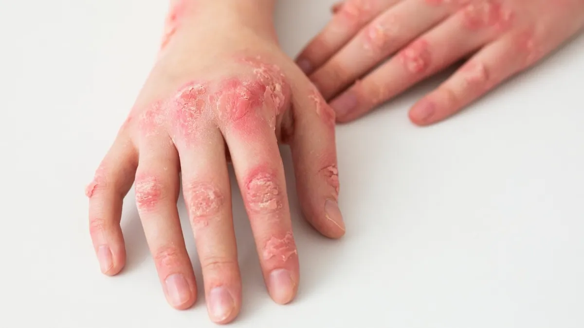 Fungal Infection: Types, Symptoms, and Treatments