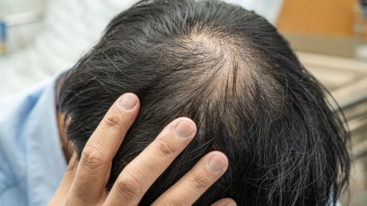 Hair Loss Treatment: Causes and Solutions