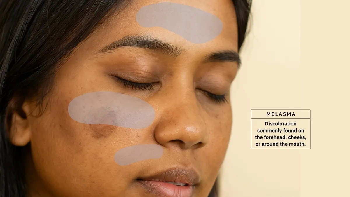 Melasma: Causes, Symptoms, and Treatment