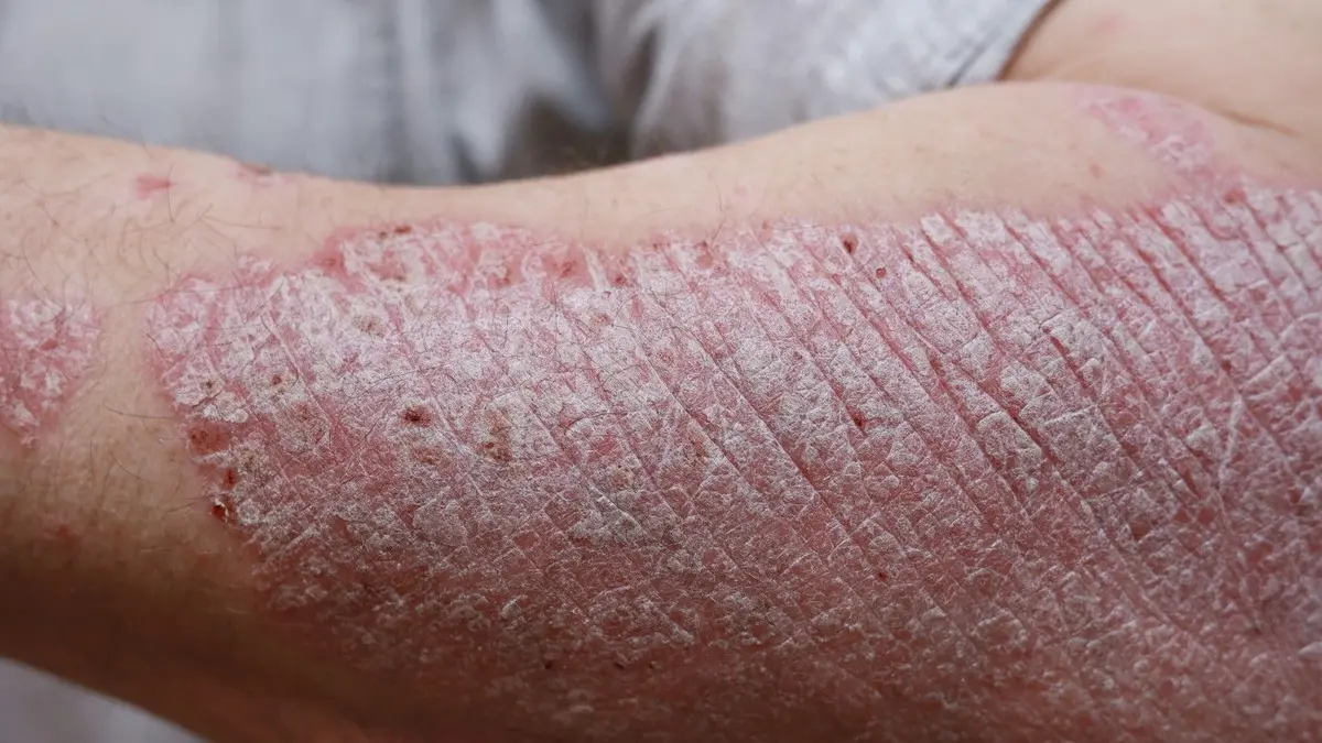 Psoriasis Symptoms, Causes, and Treatment Options