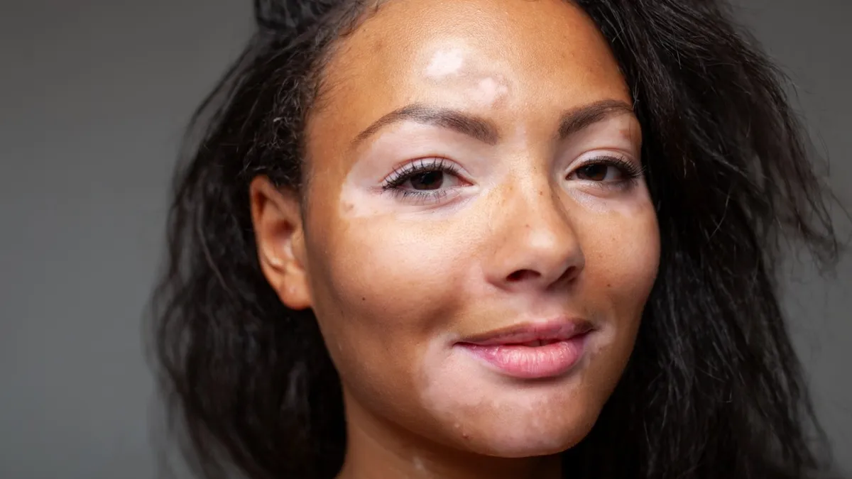 Vitiligo Symptoms, Causes, and Treatment Options